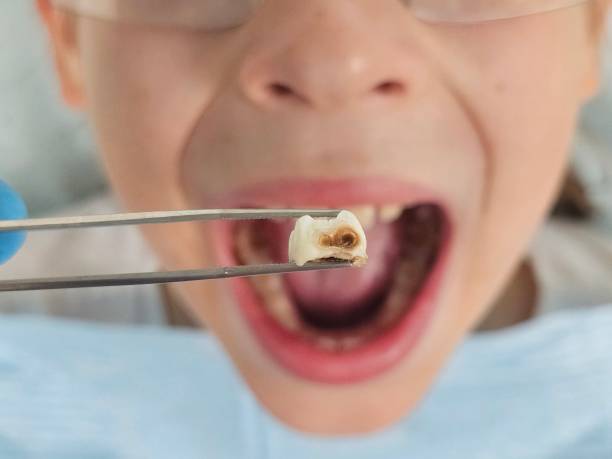 Best Emergency Tooth Extraction in Westwood Lakes, FL